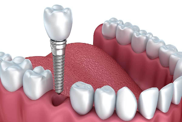 Basic in Implantology