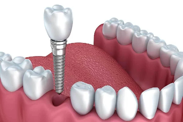 Basic in Implantology