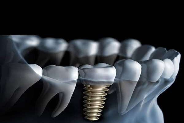 Advanced Procedure in Implantology