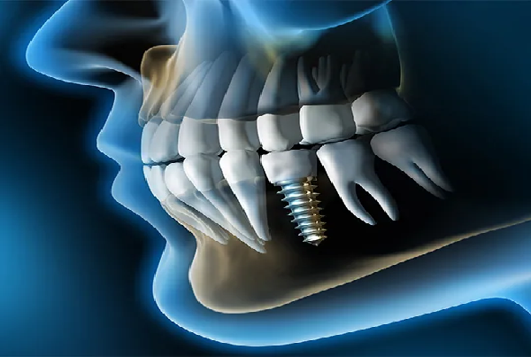 3D Guided Surgeries