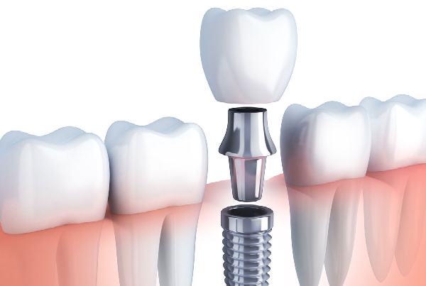 Workshop on Understand Your Implant